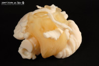 3D Printing Aids Tumor-Removal Surgery