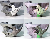 Man Receives 3D Printed Facial Reconstruction