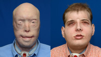 3D Printing Assists Complex Face Transplant