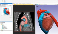New AI-Based Heart Segmentation in Simpleware Q-2020.06